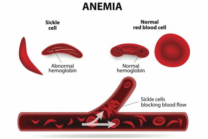 Anemija srpastih celic